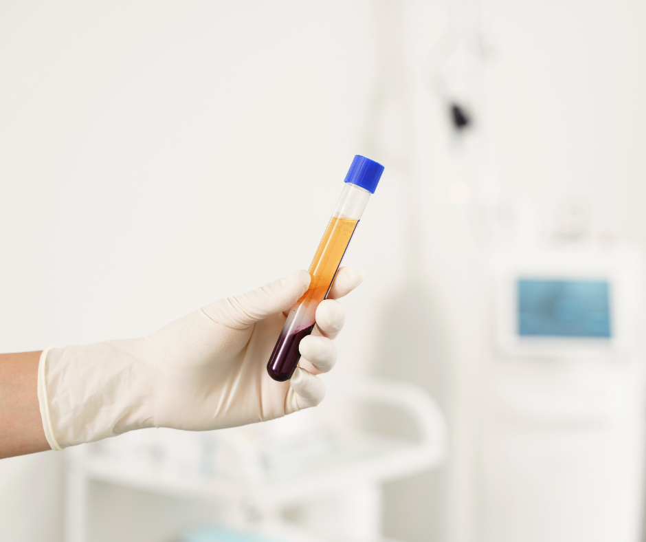 Liquid Gold PRP with Microneedling