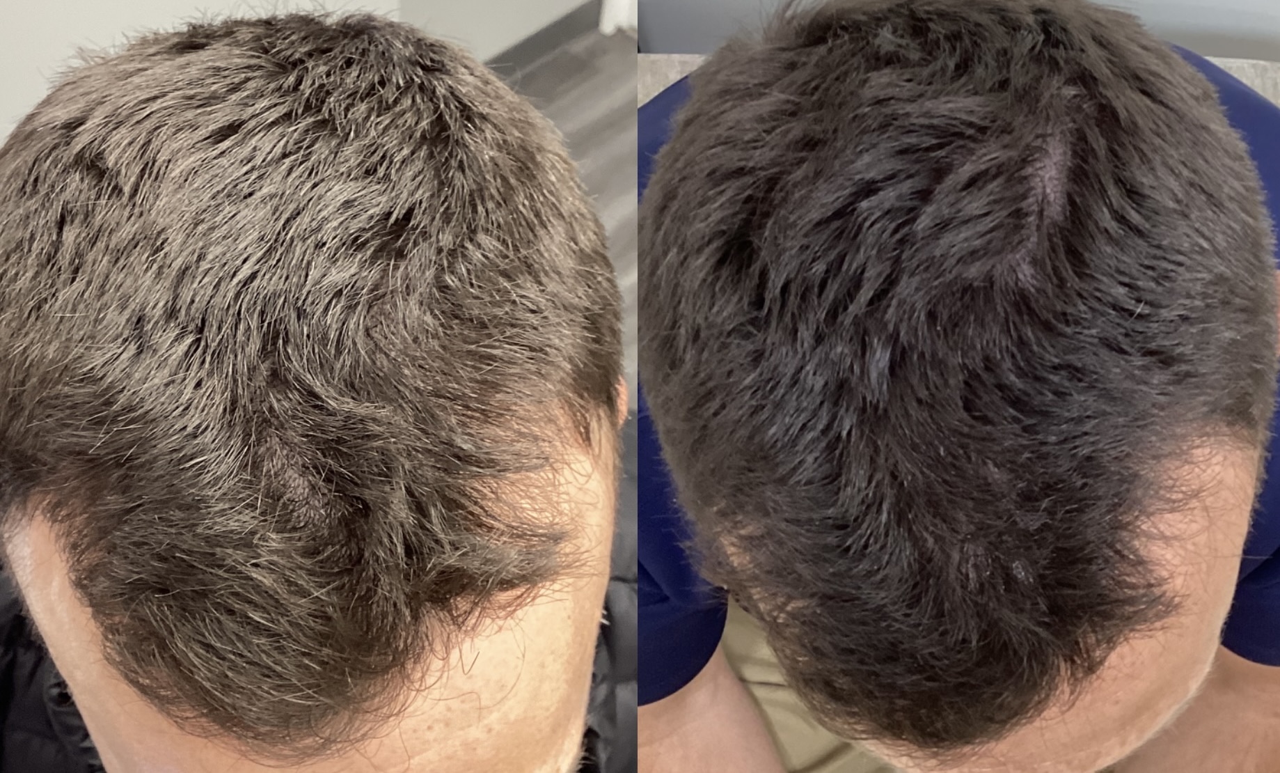 PRP Hair Restoration
